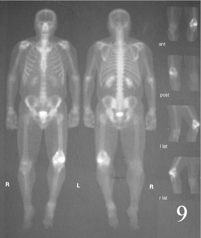 Giant Cell Tumor Of Bone Bone Tumors